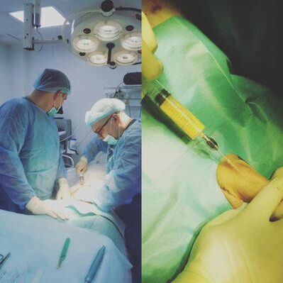 Ztluštění penisu je možné pomocí operace