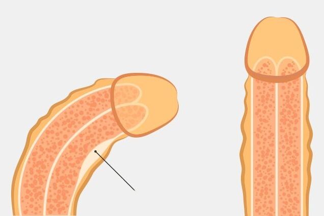 účinný způsob, jak narovnat penis