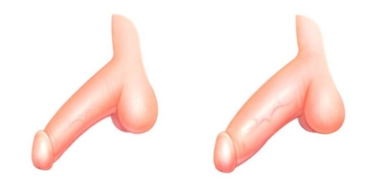 penis před a po zvětšení